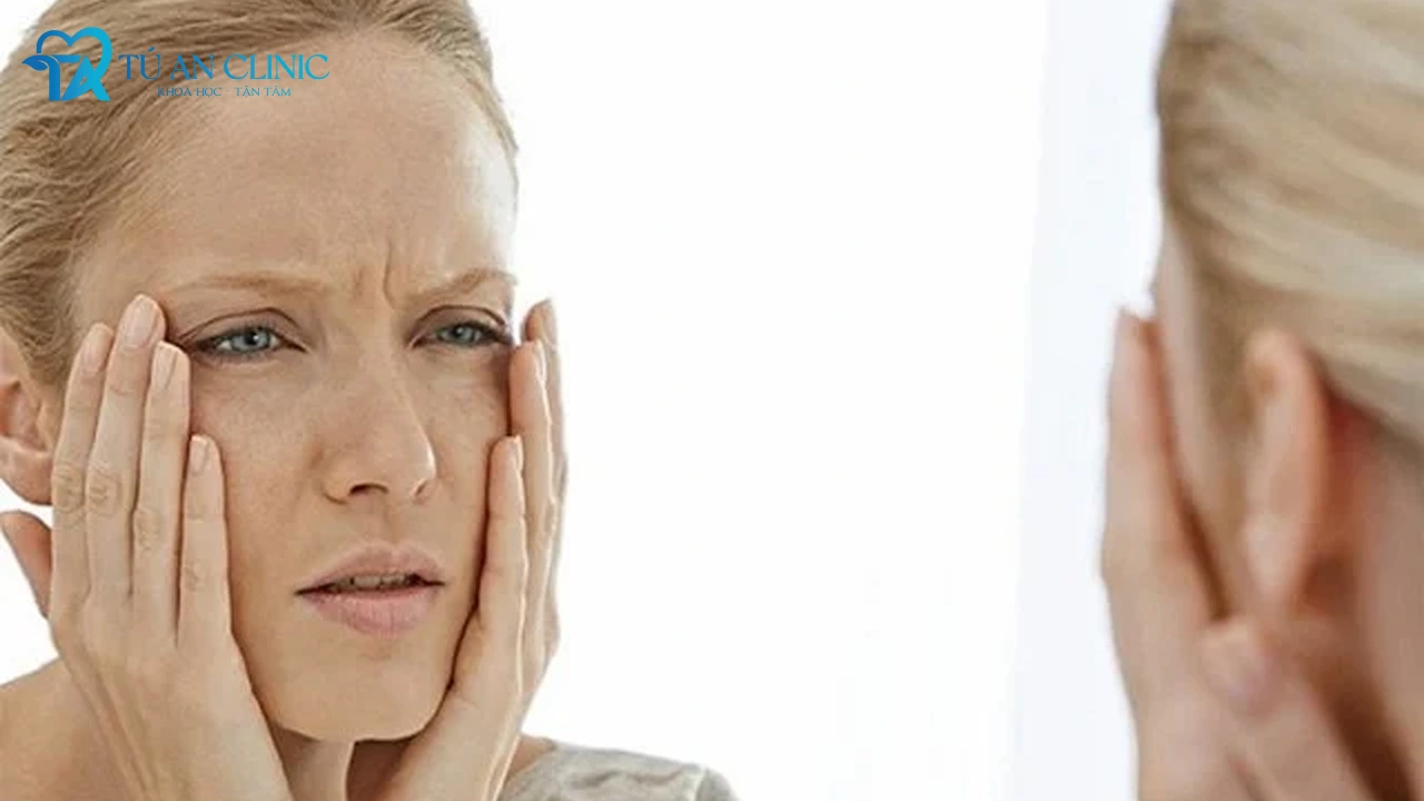 4 tác hại của căng chỉ collagen bạn cần nắm rõ
