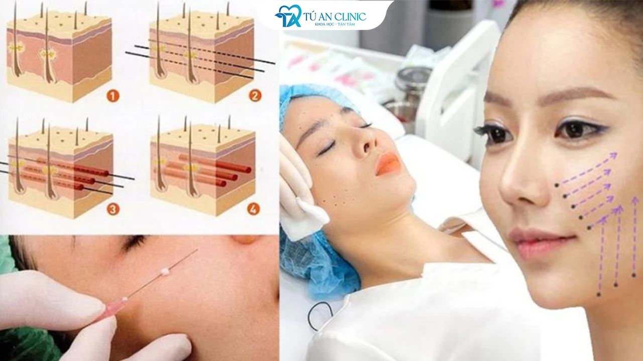 Căng chỉ da mặt có nguy hiểm không? Cách phòng tránh biến chứng căng chỉ
