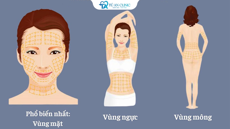 cang-da-chi-vang-webp-5-1 căng da chỉ vàng