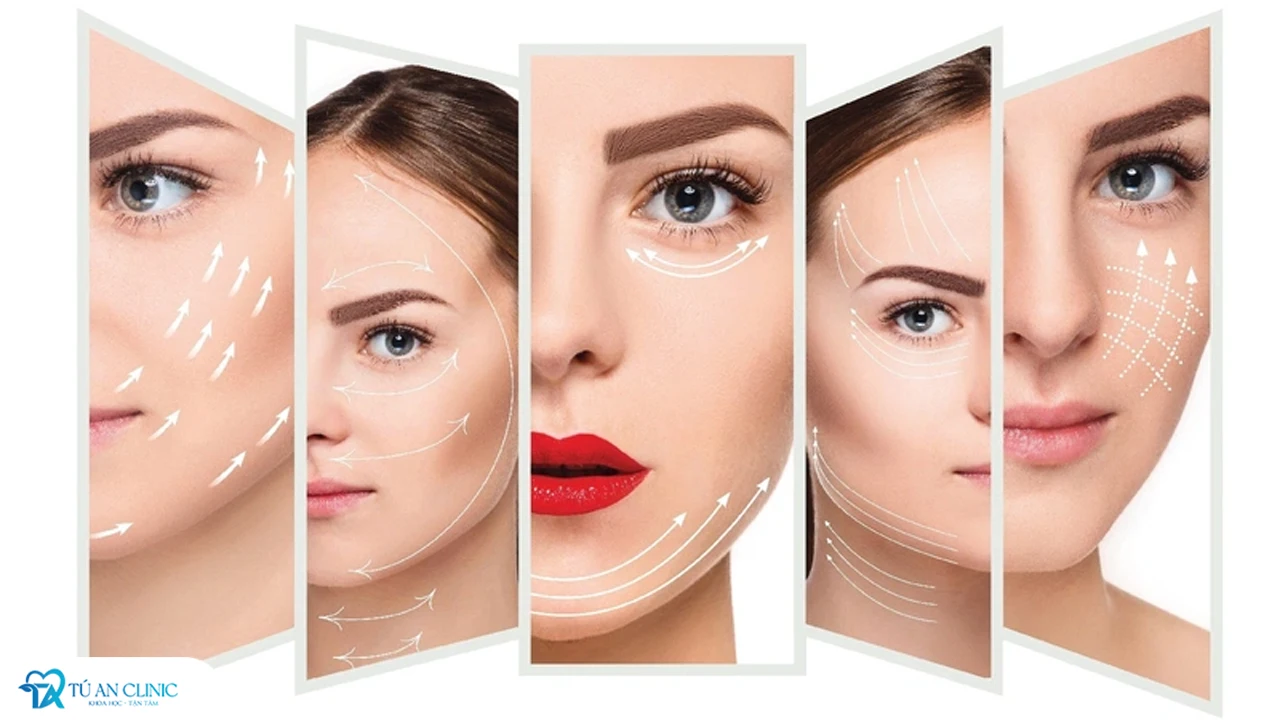 Căng da mặt bằng chỉ collagen như thế nào? Giá dịch vụ mới nhất 2024