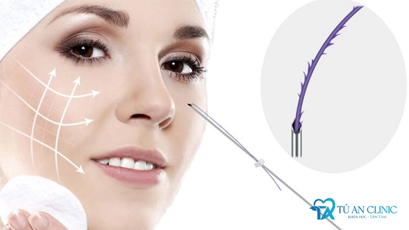 cay-chi-cang-da-mat-co-tot-khong-webp-5-1 cấy chỉ căng da mặt có tốt không