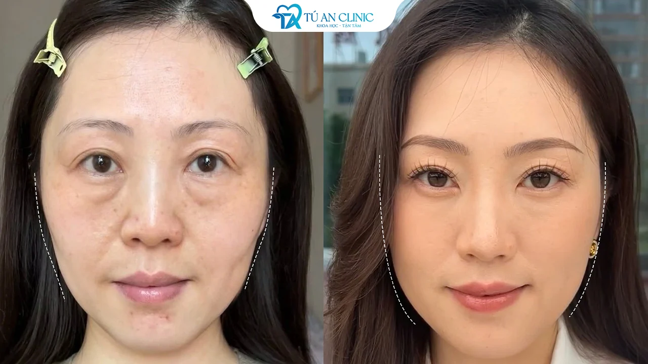 Các phương pháp làm đầy thái dương lõm ít xâm lấn hiện nay