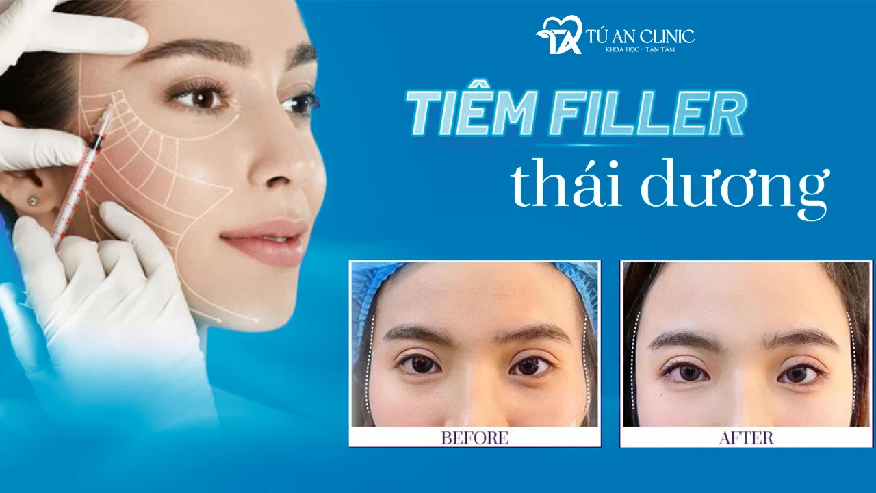 Làm đầy thái dương không để lại sẹo với phương pháp Tiêm thái dương hóp