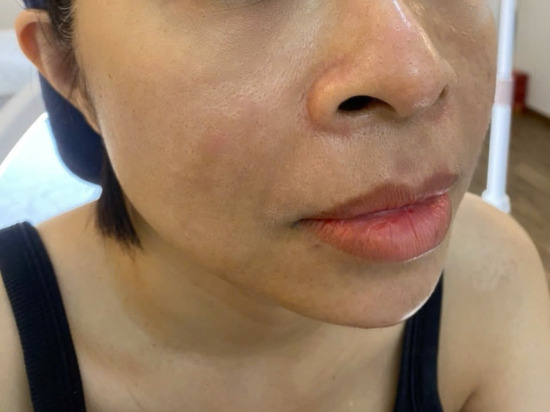 After tiêm filler cằm After tiêm filler cằm