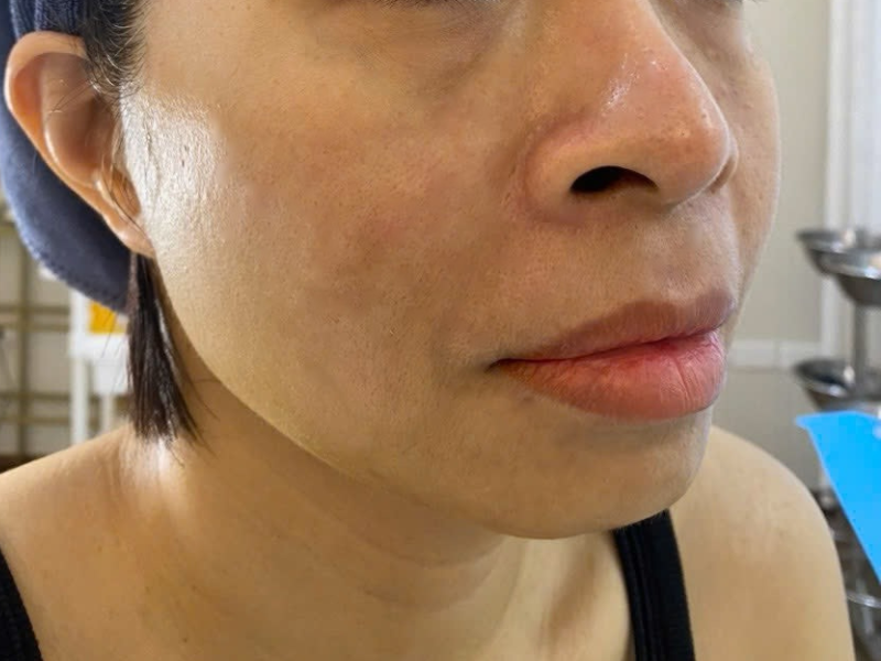 Before tiêm filler cằm Before tiêm filler cằm